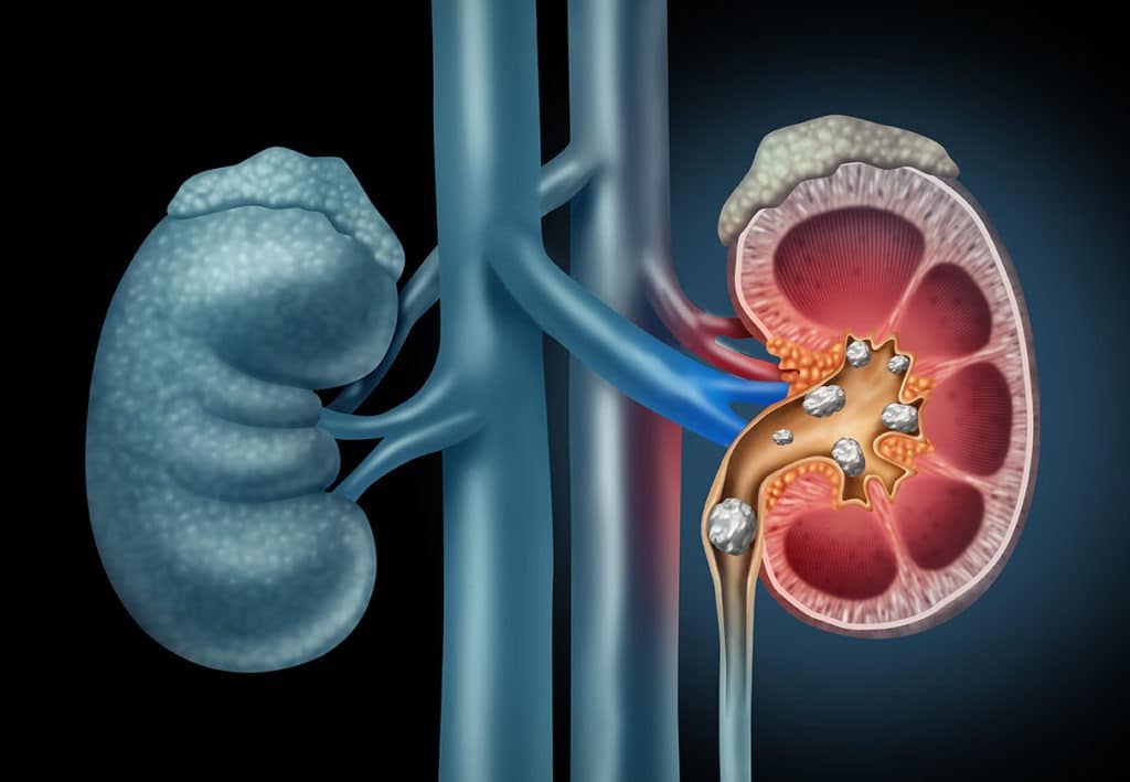 Kidney stones illustration