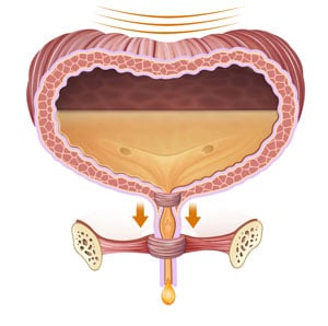 Anatomical and descriptive illustration of the bladder with urine - Urinary Incontinence