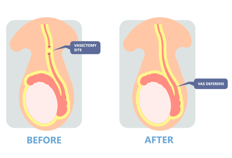reverse vasectomy illustration.