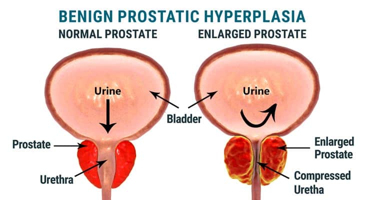 Benign prostatic hyperplasia, illustration showing normal and enlarged prostate gland