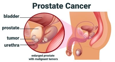 Prostate Cancer medical illustration