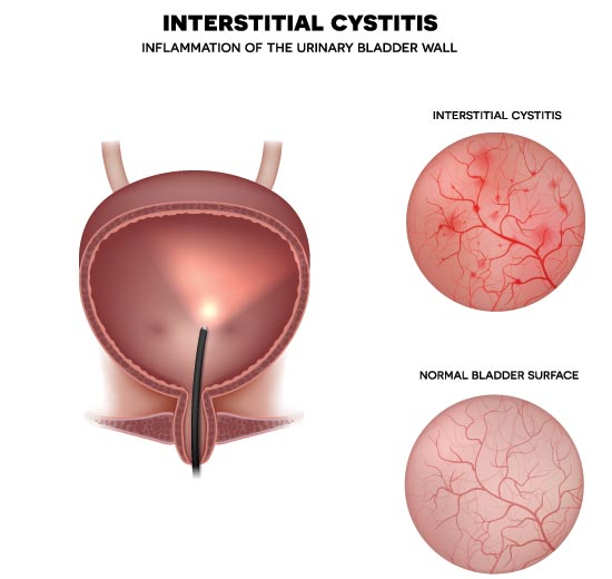 Interstitial Cystitis: Inflammation of the Urinary Bladder Wall. - Illustrations of Interstitial Cystitis & Normal Bladder Surface