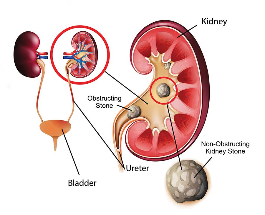Medical Illustration of a Kidney & Kidney Stone
